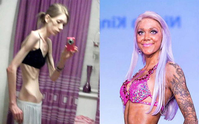Anoreksiya xəstəsi gözəllik müsabiqəsində birinci oldu – FOTO