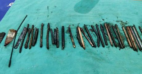 Həkimlər şokda: Xəstənin mədəsindən 33 yad cisim çıxarıldı – FOTO