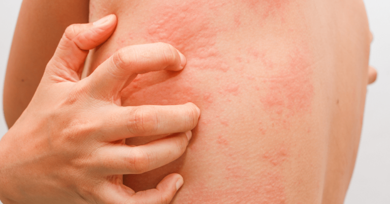 Vətəndaşları süründürən allergiya MÜRACİƏTİ: Hansı halda 2-ci doza vurulmamalıdır? – AÇIQLAMA