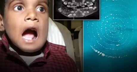 ŞOK HADİSƏ: 7 yaşlı uşağın ağzından 526 diş çıxarıldı – FOTO